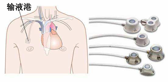普外科静疗组完成新区首例输液港植入术